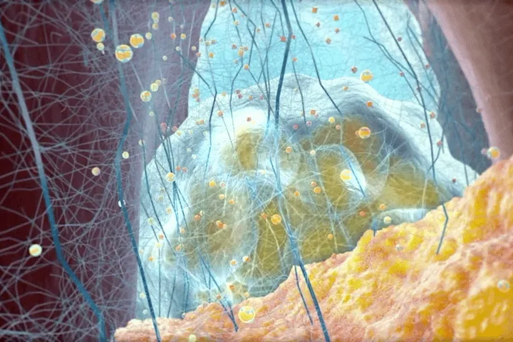 Depiction of atherosclerosis